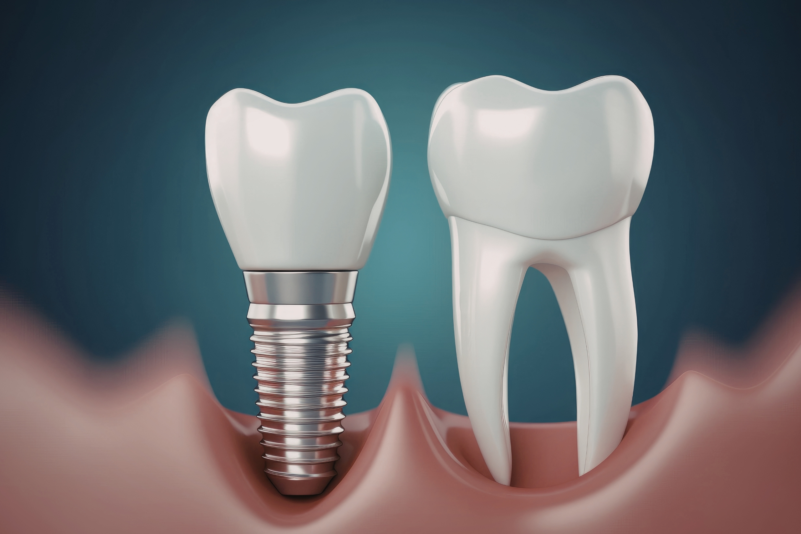 Teeth Implants Abroad - What You Need To Know