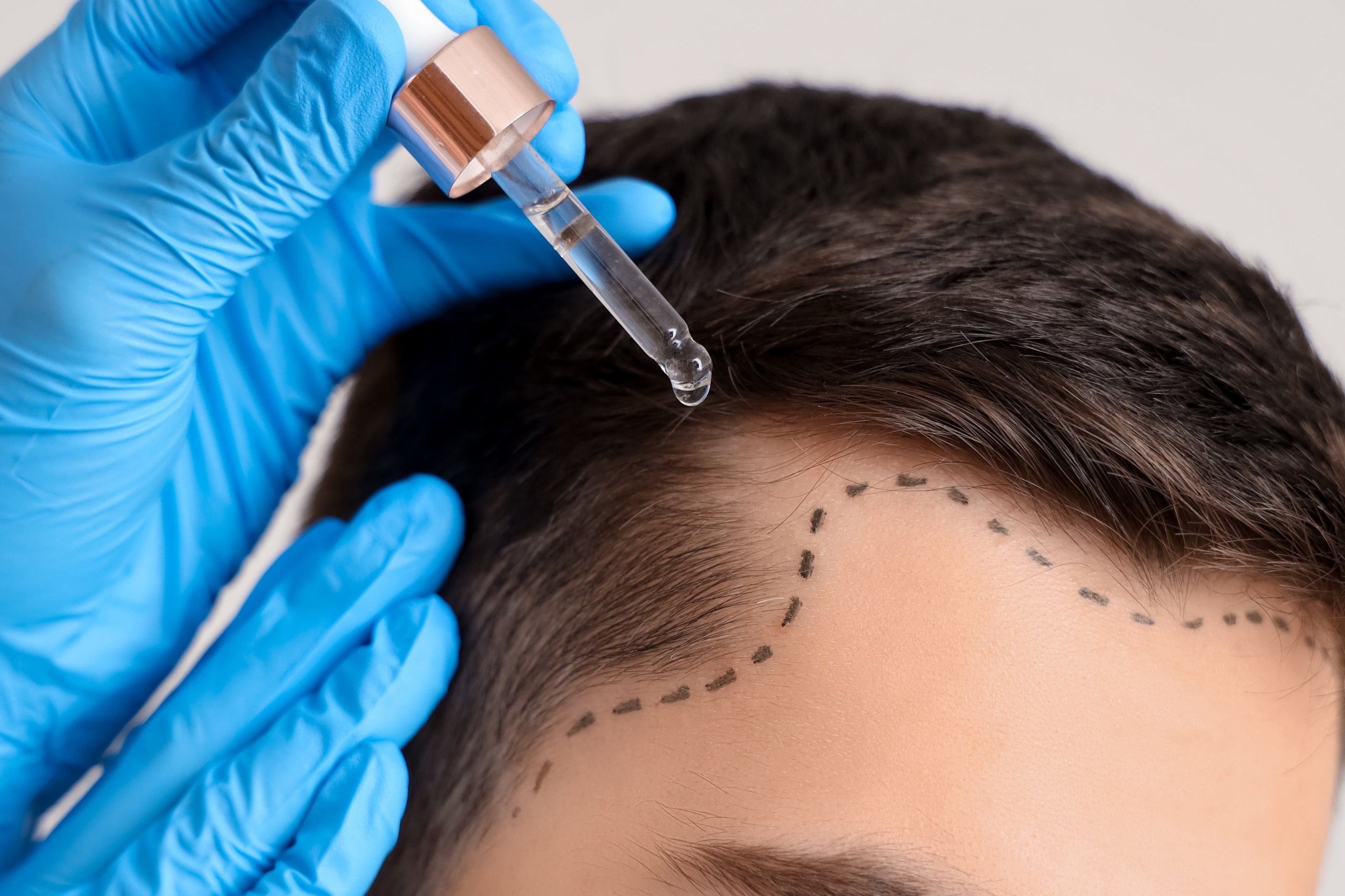 How Much Does Hair Transplant in Turkiye Cost